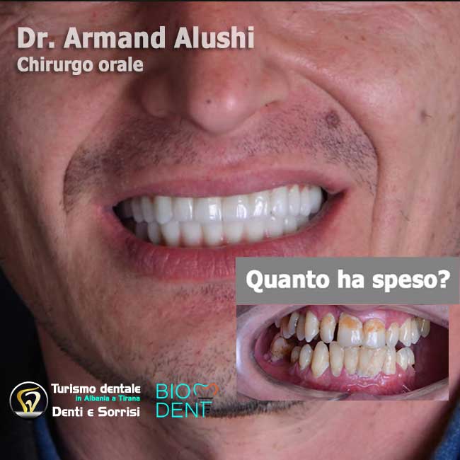 inserimento-di-3-impianti-dentali-più-cure-dei-denti-e-l'applicazione-di-24-corone-in-zirconio-in-albania-a-tirana-prezzi