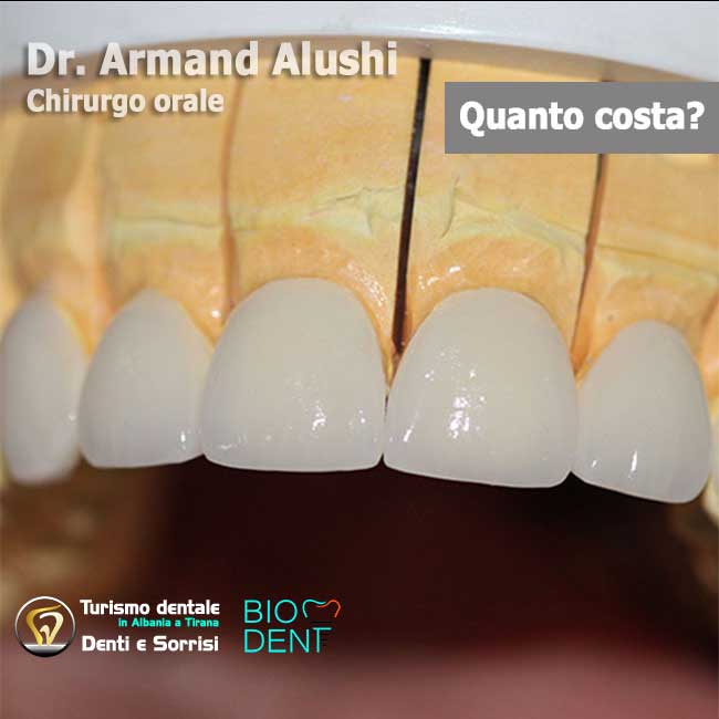 denti-in-metallo-ceramica-per-estetica-dentale-in-albania-a-tirana