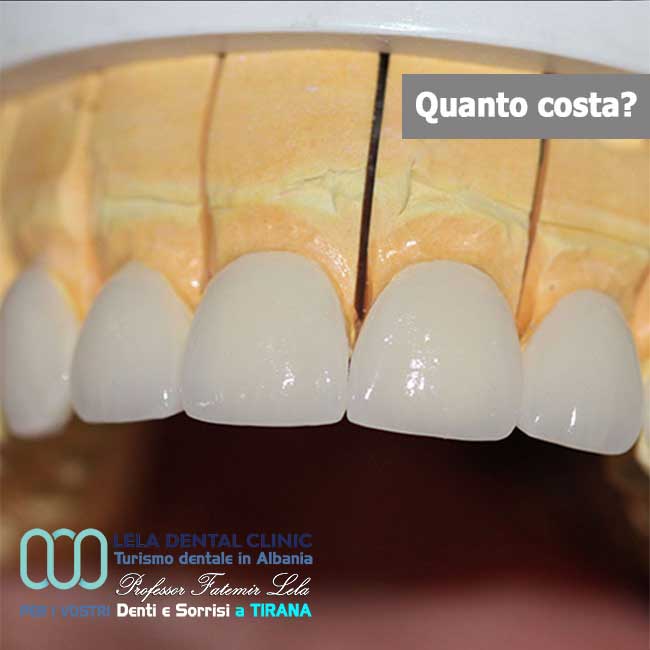 denti-in-metallo-ceramica-per-estetica-dentale-in-albania-a-tirana