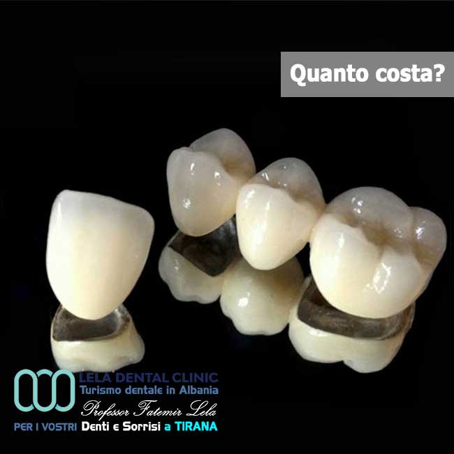 denti-corone-o-capsule-e-ponti-in metallo-ceramica-in-albania-a-tirana