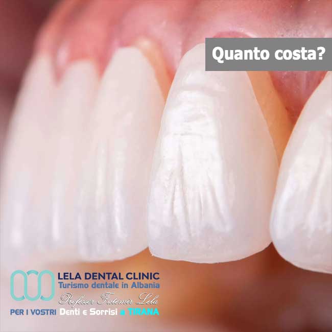 faccette-dentali-emax-in-ceramica-integrale-in-albania-a-tirana