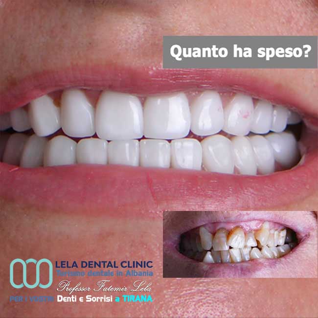 estetica-dentale-con-2-all-on-four-tutto-su-8-impianti-dentali-e-24-corone-in-zirconio-in-albania-a-tirana