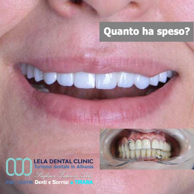 estetica-dentale-con-2-all-on-six-tutto-su-12-impianti-dentali-e-24-corone-in-zirconio-in-albania-a-tirana