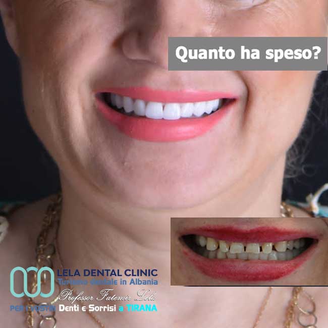 estetica-dentale-senza-cure-dentali-di-24-corone-in-zirconio-applicate-sui-propri-denti-in-albania-a-tirana