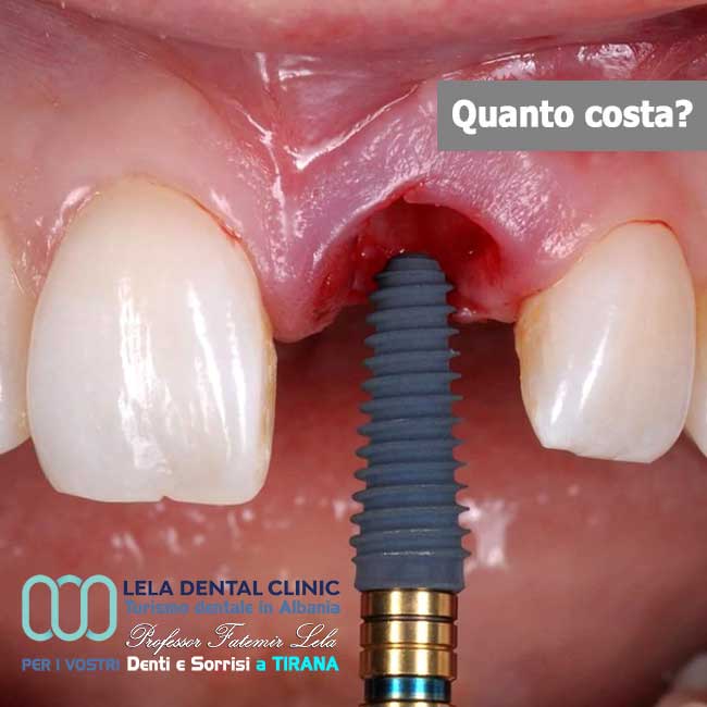 Impianto-dentale-per-dente-singolo-blog