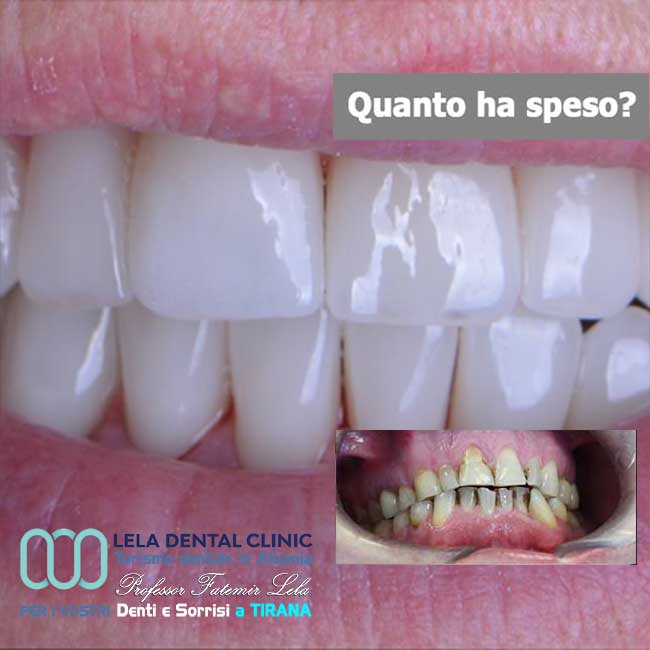 cure-canalarie-e-cure-carie-e-preparazione-dei-denti-con-limatura-per-l'applicazione-di-24-corone-in-zirconio-in-albania-a-tirana