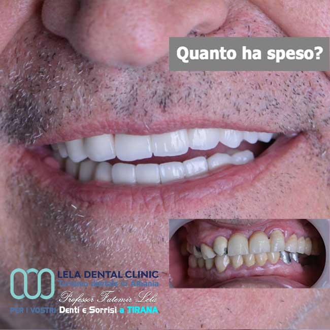 sostituzione-di-vecchie-corone-in-metallo-ceramica-con-24-corone-in-zirconio-con-cure-dentali-in-albania-a-tirana