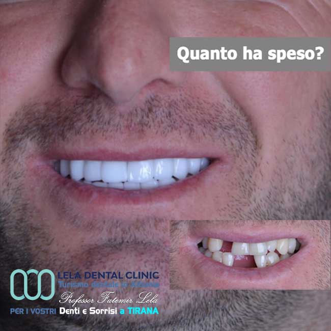 implantologia-di-4-impianti-dentali-con-cure-dentali-e-l'applicazione-di-24-corone-in-zirconio-in-albania-a-tirana