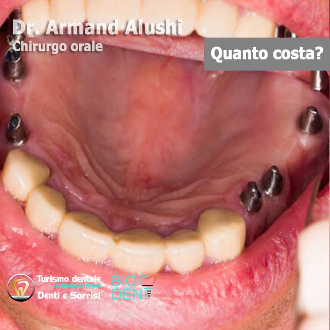 12-impianti-dentali-per-ripristino-arcata-dentale-in-albania-a-tirana-prezzi