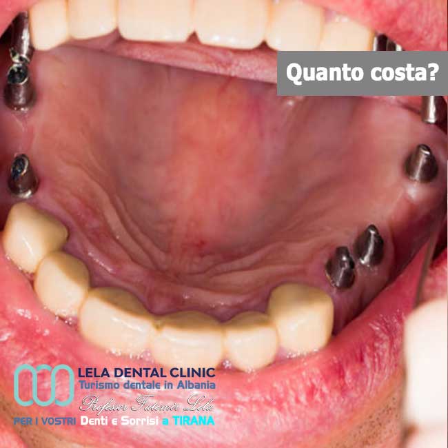 Impianti-dentali-per-ripristino-arcate-dentali-blog