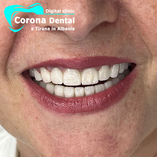 primo-dentista-corona-dental