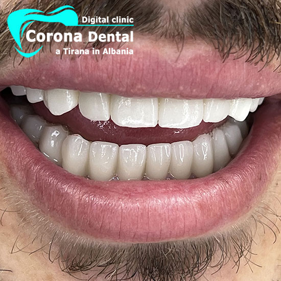 decimo-dentista-corona-dental
