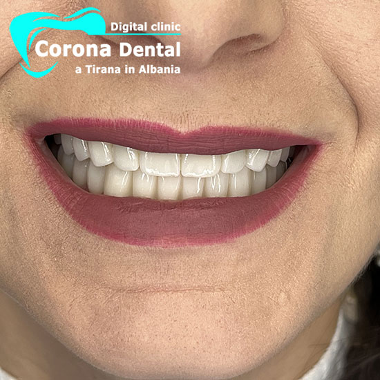 undicesimo-dentista-corona-dental