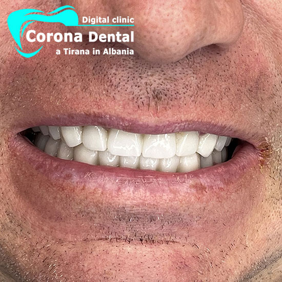 dodicesimo-dentista-corona-dental
