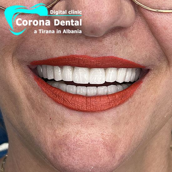 primo-odontotecnico-corona-dental