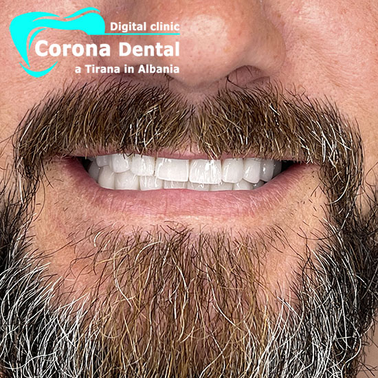 secondo-odontotecnico-corona-dental