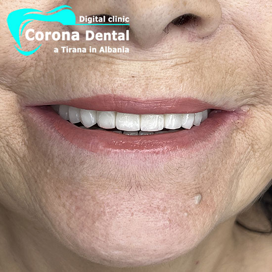 terzo-odontotecnico-corona-dental