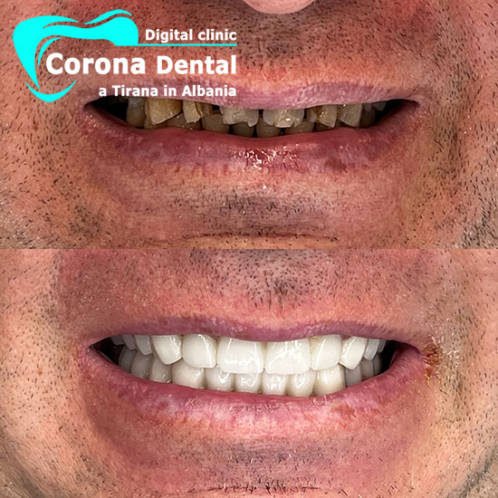 quarto-odontotecnico-corona-dental