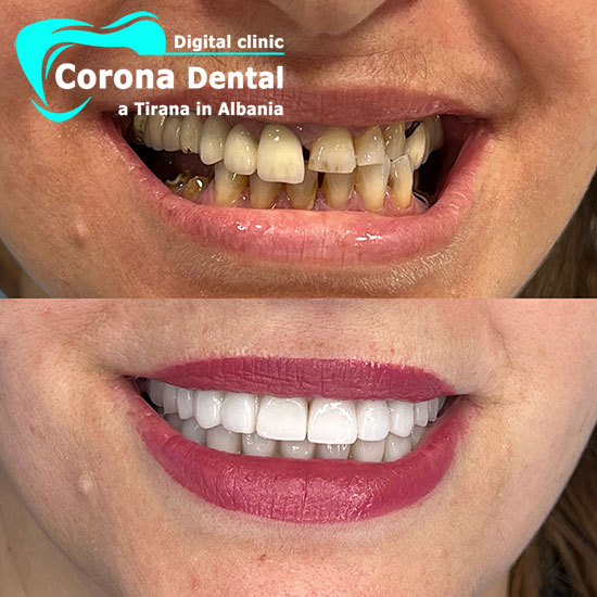 quinto-odontotecnico-corona-dental
