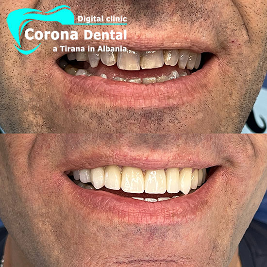 sesto-odontotecnico-corona-dental