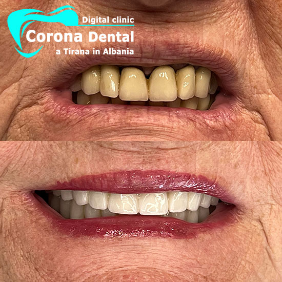 settimo-odontotecnico-corona-dental
