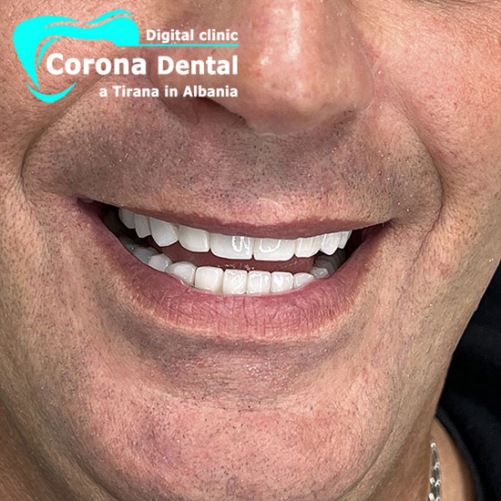 secondo-dentista-corona-dental