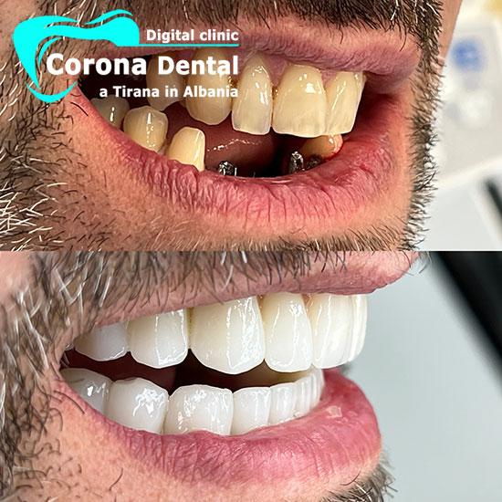 ottavo-odontotecnico-corona-dental