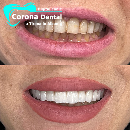 nono-odontotecnico-corona-dental