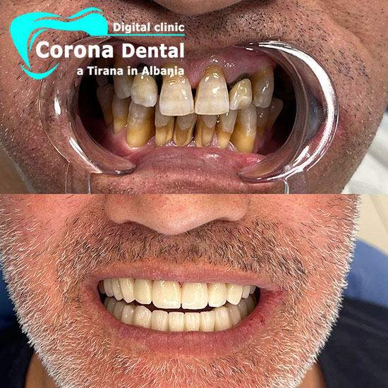 ottavo-odontotecnico-corona-dental