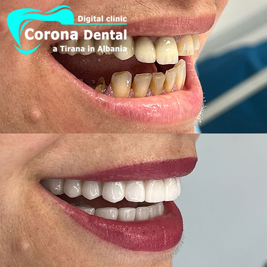 ottavo-odontotecnico-corona-dental