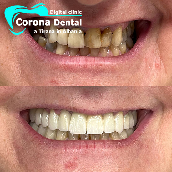 ottavo-odontotecnico-corona-dental