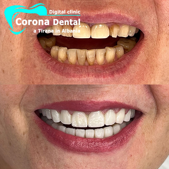 ottavo-odontotecnico-corona-dental