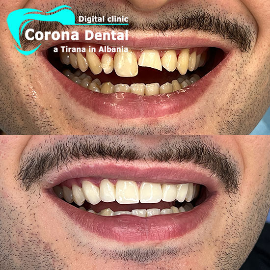 ottavo-odontotecnico-corona-dental