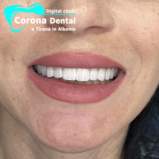 terzo-dentista-corona-dental