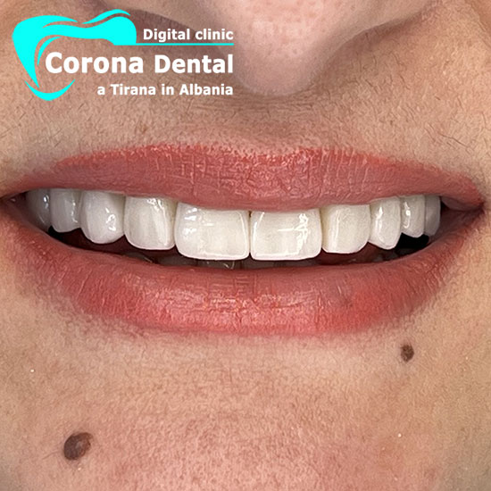 quinto-dentista-corona-dental