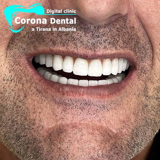 sesto-dentista-corona-dental