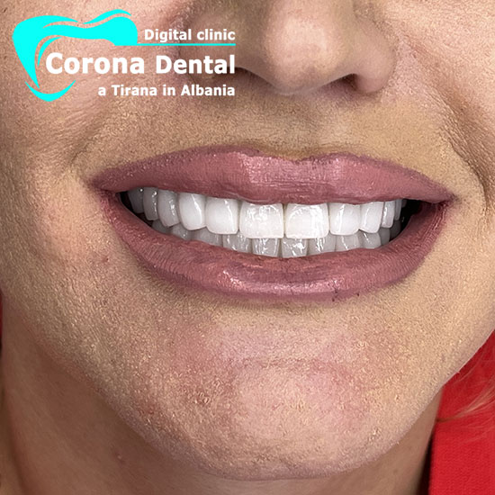 settimo-dentista-corona-dental