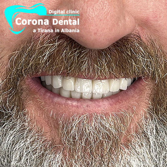 ottavo-dentista-corona-dental