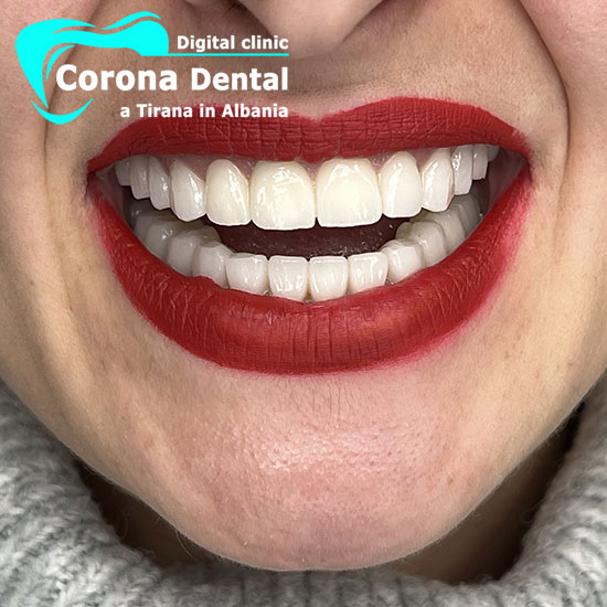 nono-dentista-corona-dental