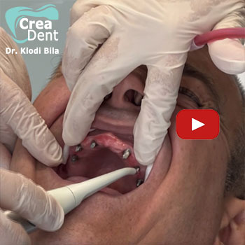 applicazione-all-on-six