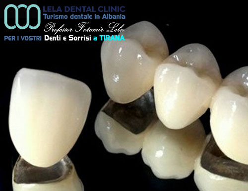 prezzo-denti-corone-in-metallo-ceramica-in-albania-a-tirana