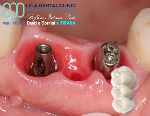prezzo-di-due-impianti-dentali-in-albania-tirana