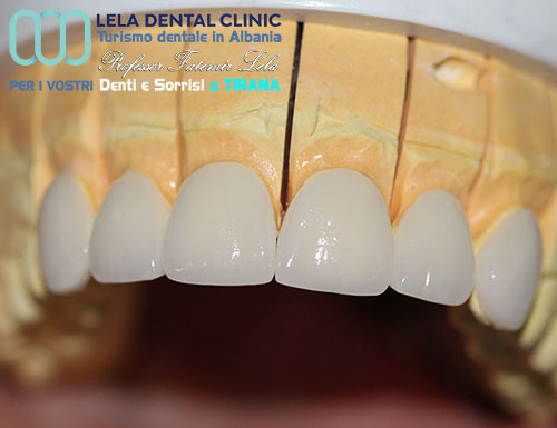 prezzo-estetica-dentale-con-denti-in-metallo-ceramica-in-albania-tirana