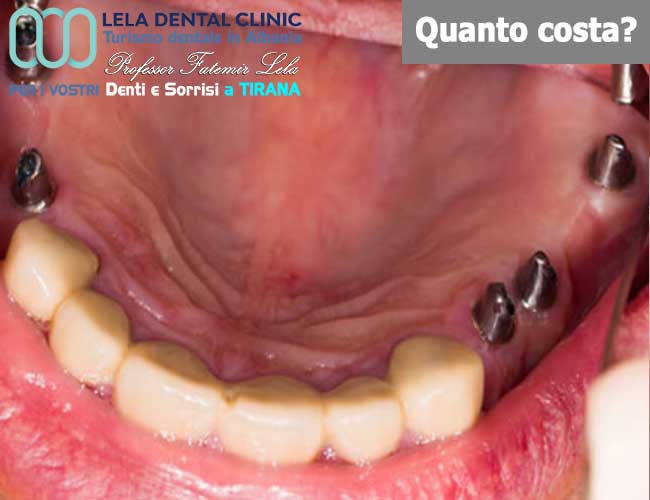 12-impianti-dentali-per-ripristino-arcata-dentale-in-Albania-a-Tirana