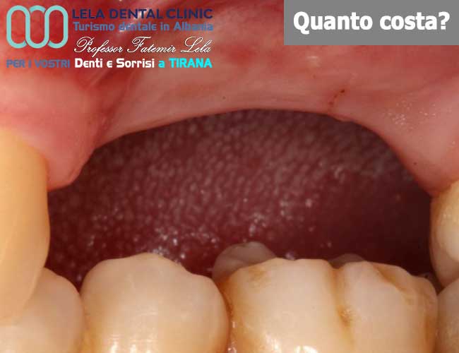 aumento-osso-per-posizioni-specifica-dei-denti-in-Albania-a-Tirana