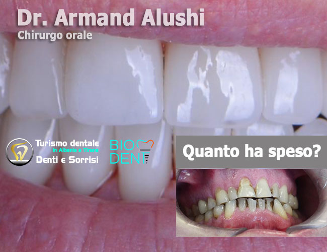 cure-canalarie-e-cure-carie-e-preparazione-dei-denti-con-limatura-per-l'applicazione-di-24-corone-in-zirconio-in-Albania-a-Tirana