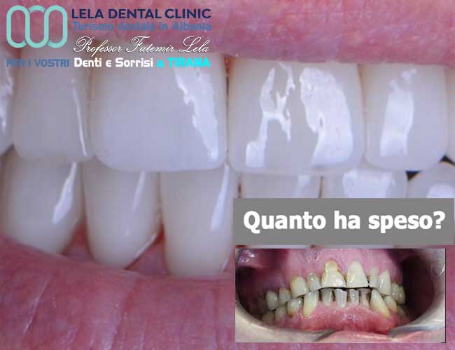 cure-canalarie-e-cure-carie-e-preparazione-dei-denti-con-limatura-per-l'applicazione-di-24-corone-in-zirconio-in-Albania-a-Tirana