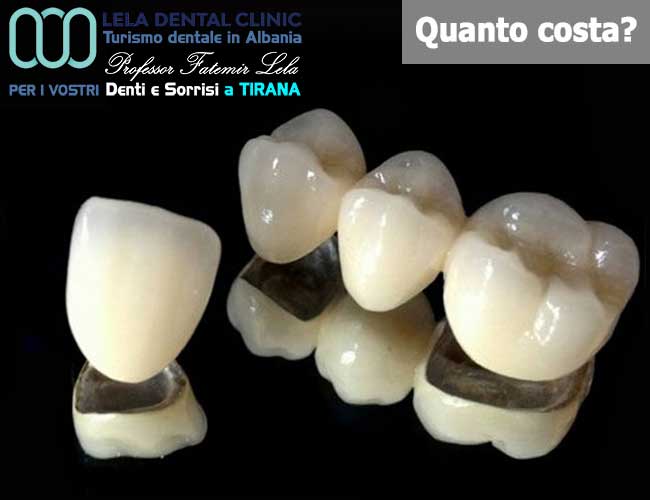 denti-corone-o-capsule-e-ponti-in-metallo-ceramica-in-Albania-a-Tirana