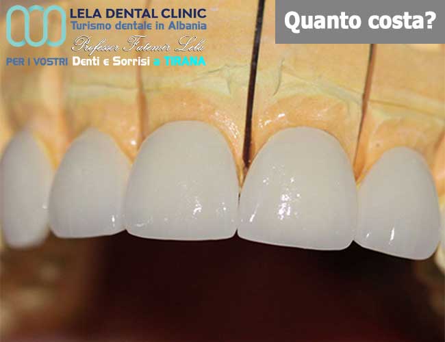 denti-in-metallo-ceramica-per-estetica-dentale-in-Albania-a-Tirana