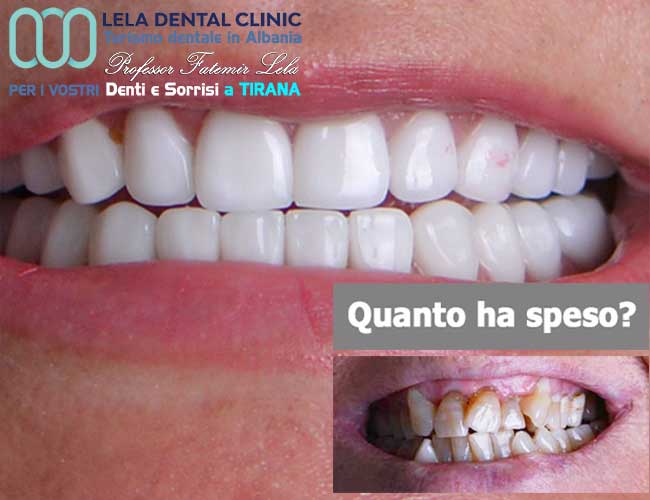 estetica-dentale-con-2-All-on-Four-tutto-su-8-impianti-dentali-e-24-corone-in-zirconio-in Albania-a-Tirana